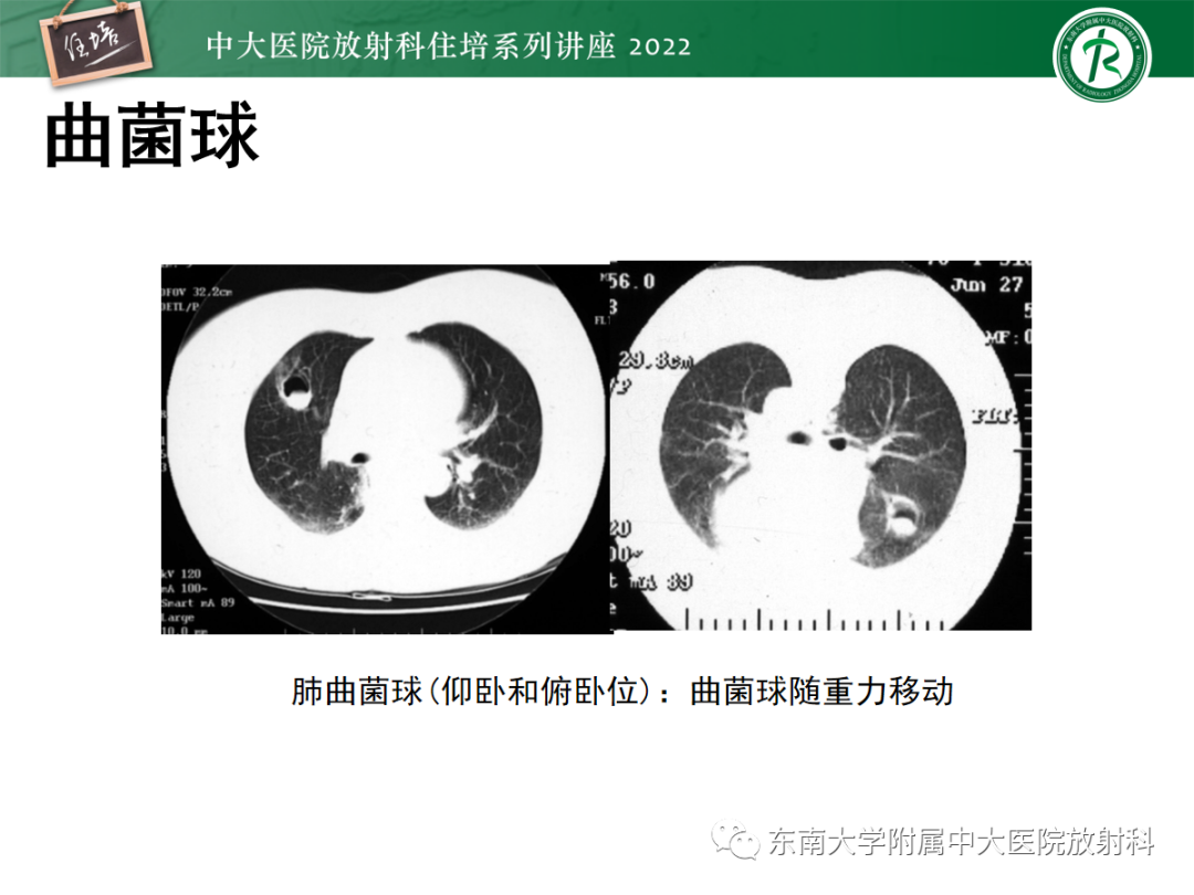 影像PPT - 【PPT】肺空腔、空洞性病变诊断分析思路-52