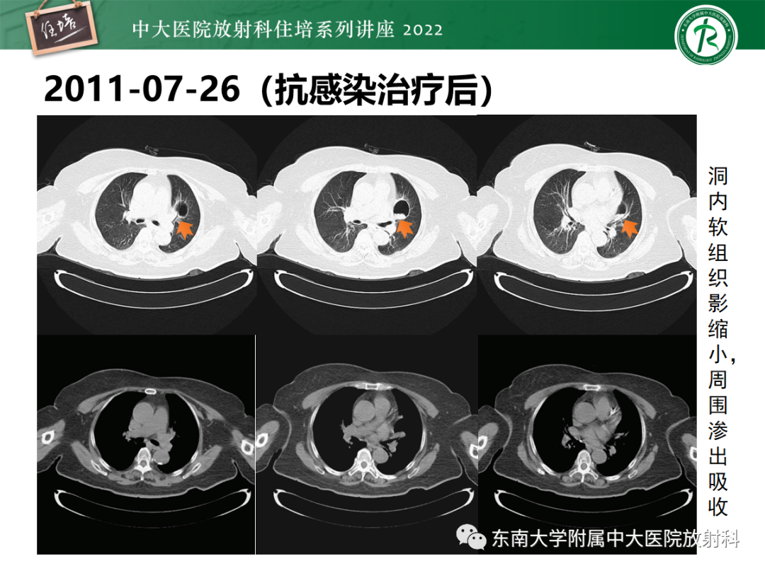 影像PPT - 【PPT】肺空腔、空洞性病变诊断分析思路-49