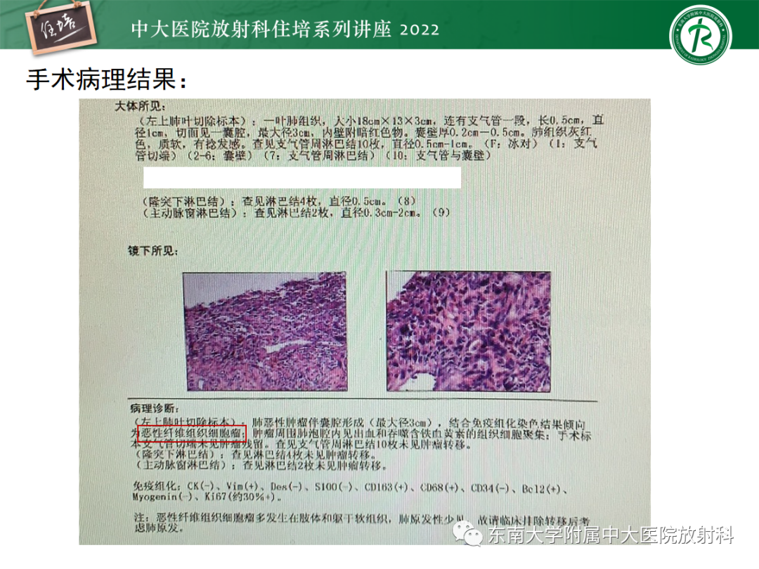 影像PPT - 【PPT】肺空腔、空洞性病变诊断分析思路-53