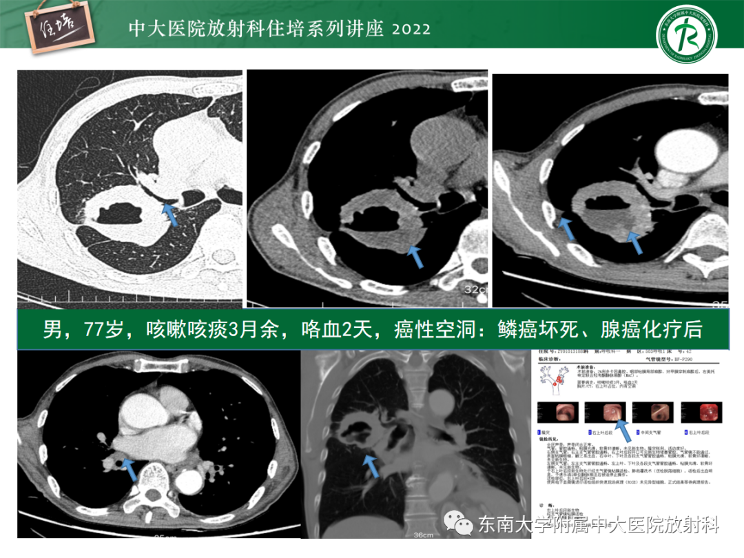 影像PPT - 【PPT】肺空腔、空洞性病变诊断分析思路-57