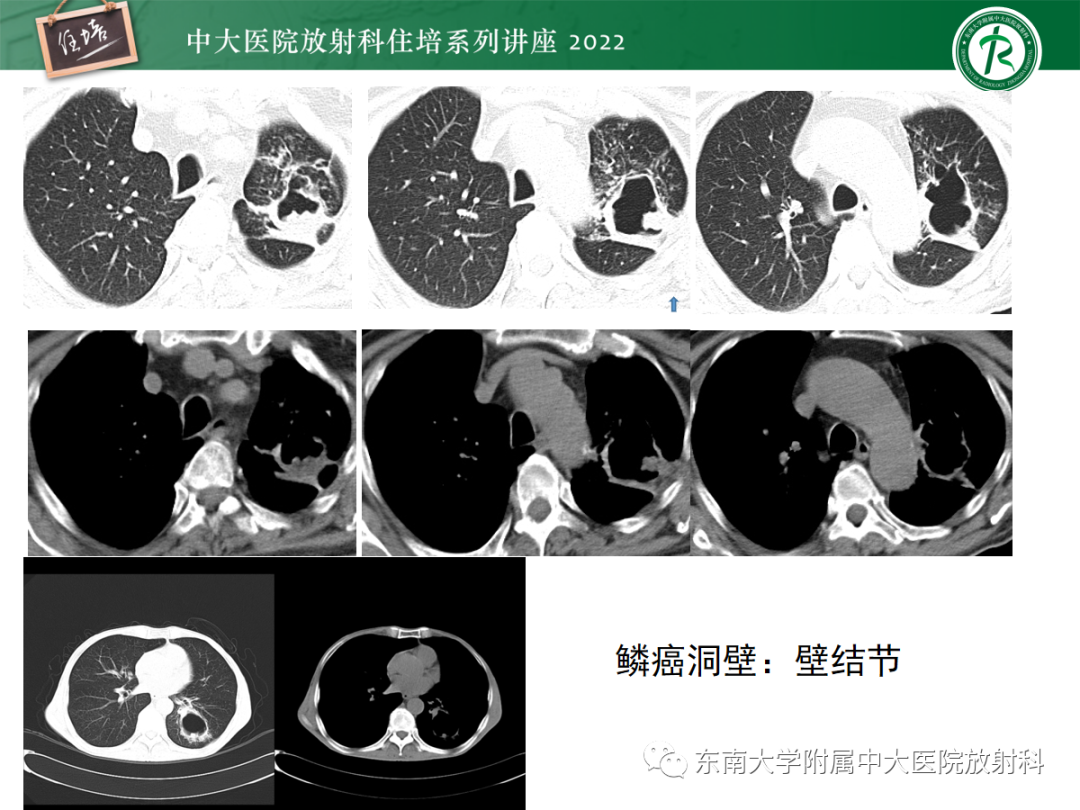 影像PPT - 【PPT】肺空腔、空洞性病变诊断分析思路-58
