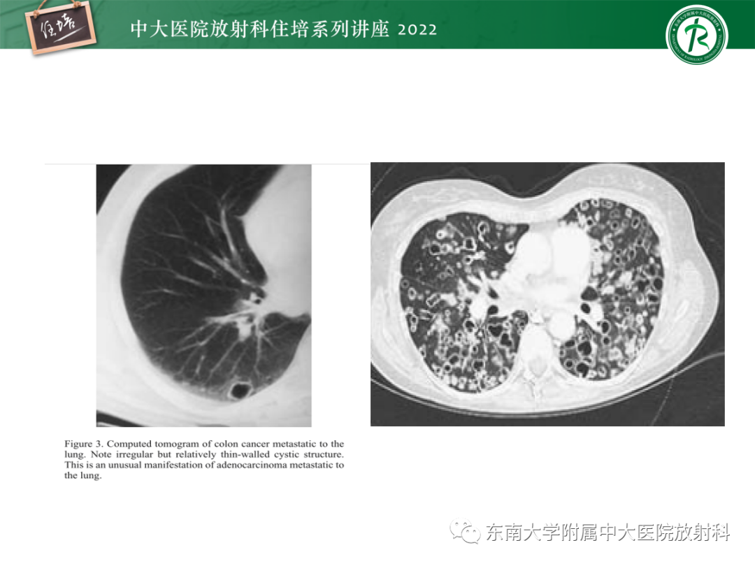 影像PPT - 【PPT】肺空腔、空洞性病变诊断分析思路-63