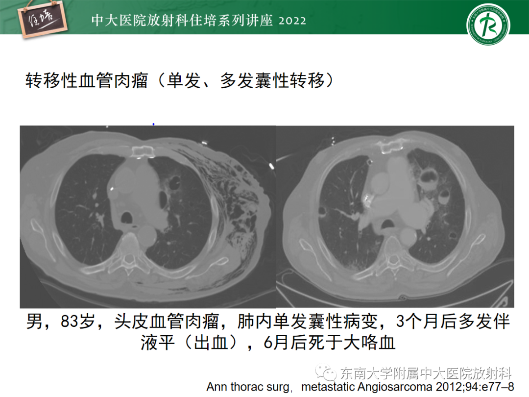 影像PPT - 【PPT】肺空腔、空洞性病变诊断分析思路-64