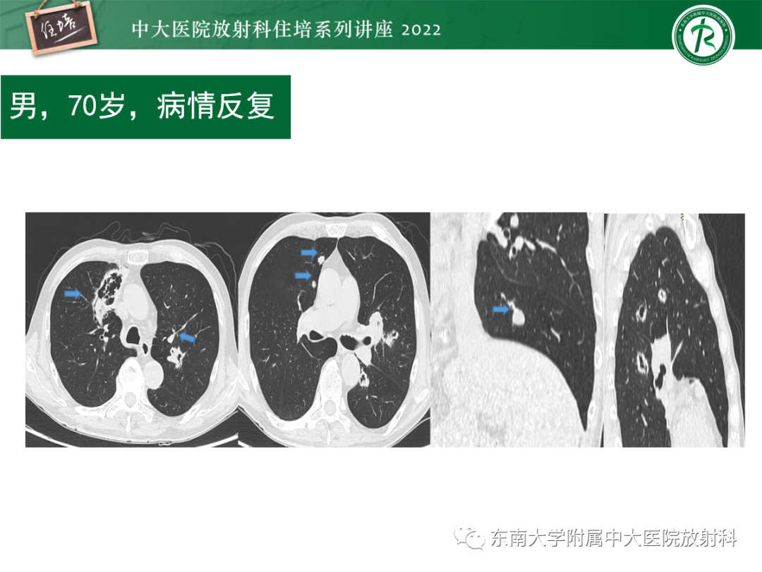 影像PPT - 【PPT】肺空腔、空洞性病变诊断分析思路-68