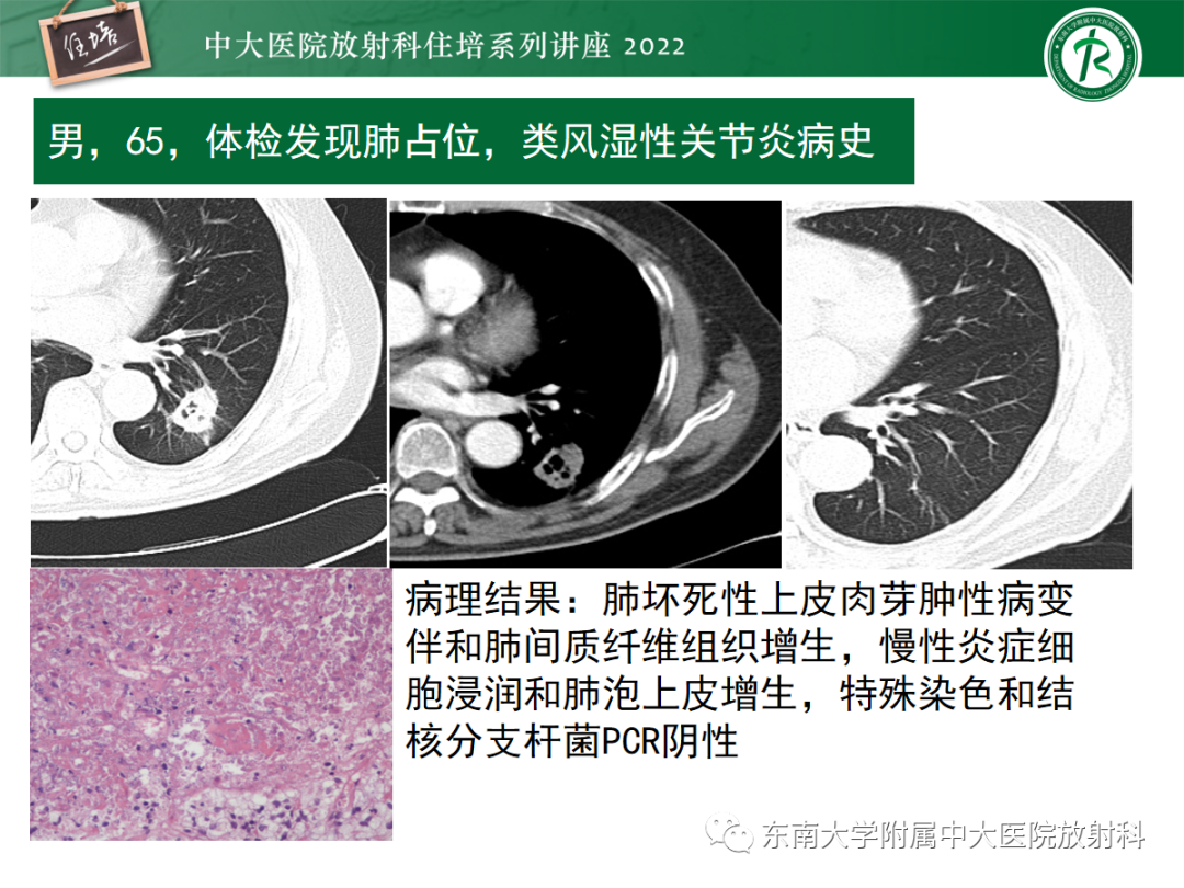 影像PPT - 【PPT】肺空腔、空洞性病变诊断分析思路-66