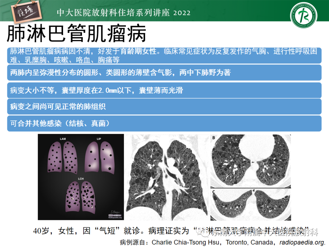 影像PPT - 【PPT】肺空腔、空洞性病变诊断分析思路-3
