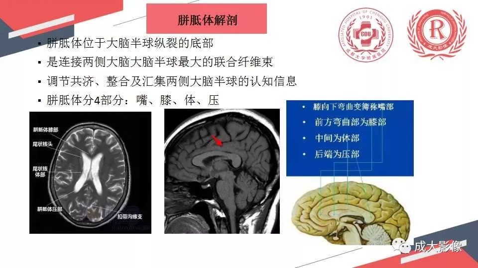 影像PPT - 【PPT】胼胝体病变MRI诊断-2