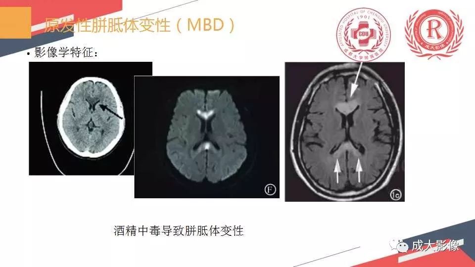 影像PPT - 【PPT】胼胝体病变MRI诊断-9