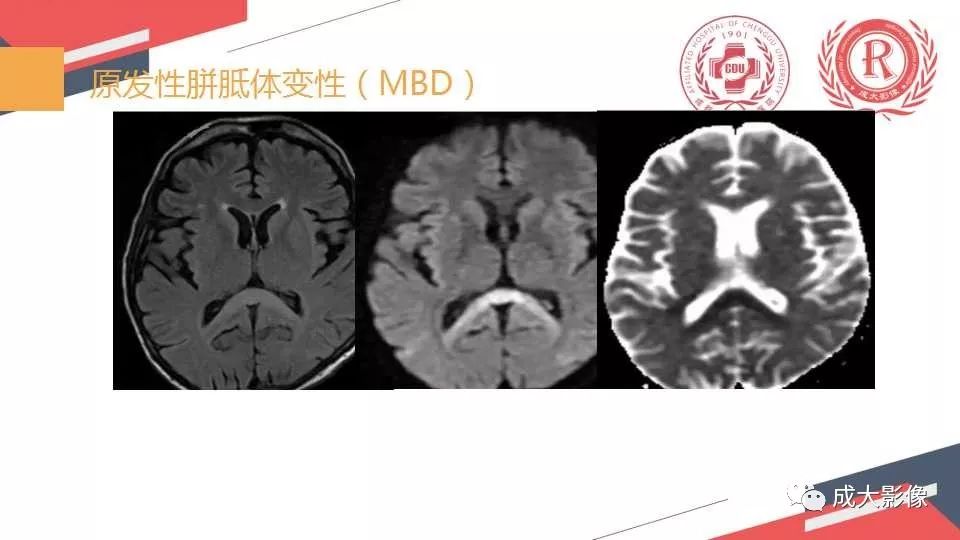 影像PPT - 【PPT】胼胝体病变MRI诊断-10
