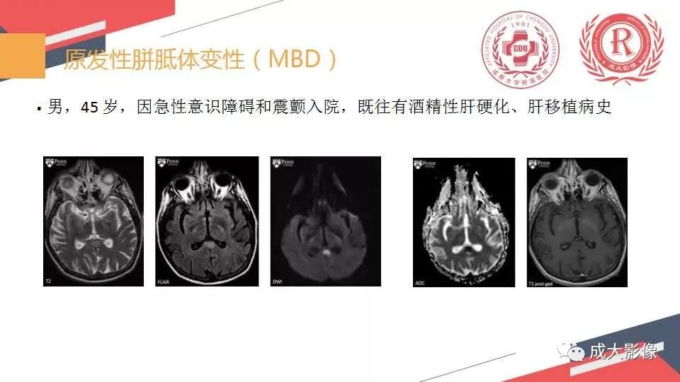 影像PPT - 【PPT】胼胝体病变MRI诊断-11