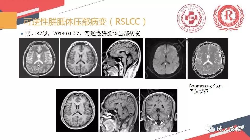 影像PPT - 【PPT】胼胝体病变MRI诊断-15
