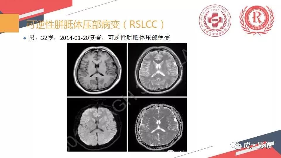 影像PPT - 【PPT】胼胝体病变MRI诊断-16