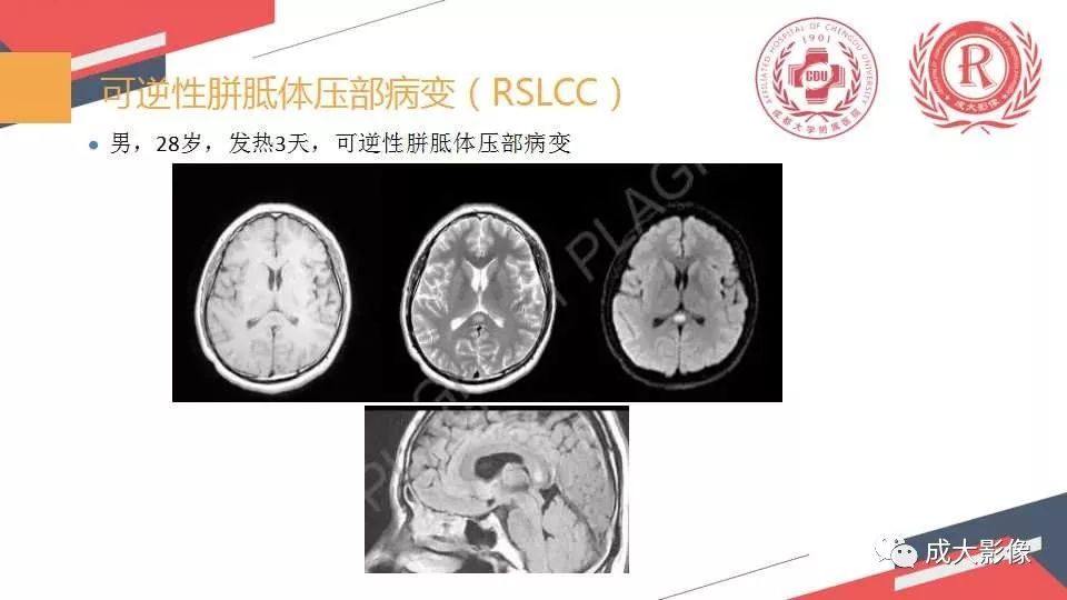 影像PPT - 【PPT】胼胝体病变MRI诊断-17