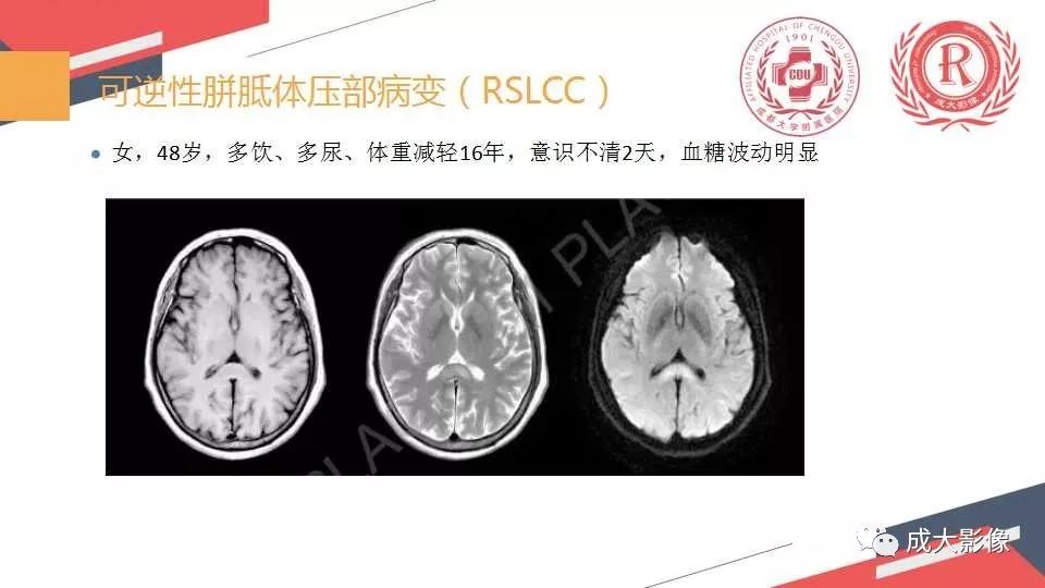 影像PPT - 【PPT】胼胝体病变MRI诊断-18