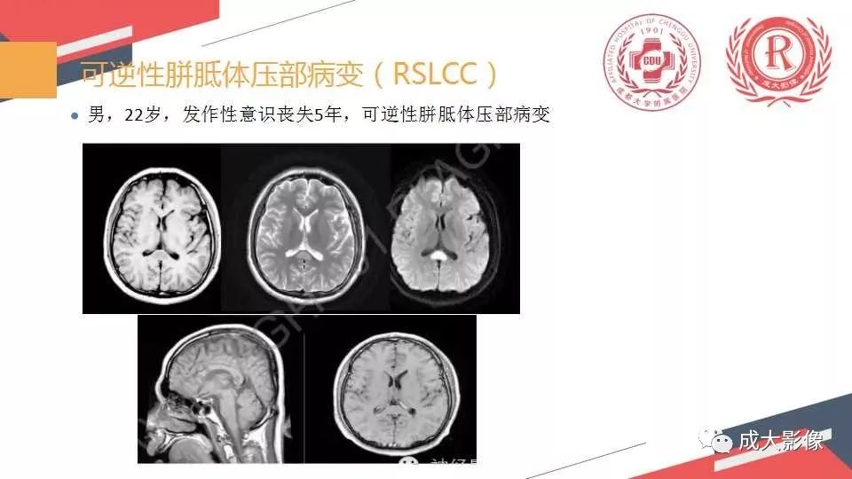 影像PPT - 【PPT】胼胝体病变MRI诊断-19
