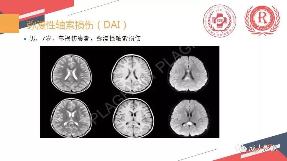 影像PPT - 【PPT】胼胝体病变MRI诊断-23