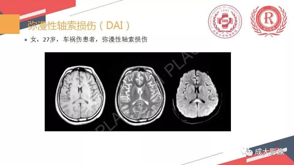 影像PPT - 【PPT】胼胝体病变MRI诊断-24