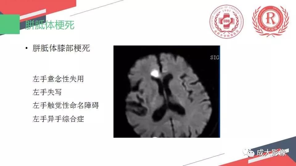 影像PPT - 【PPT】胼胝体病变MRI诊断-28