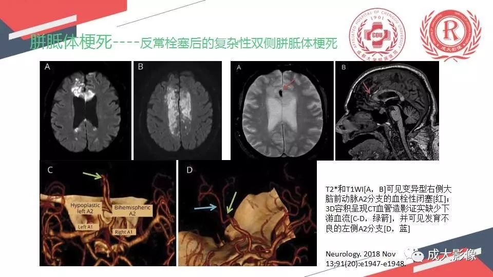 影像PPT - 【PPT】胼胝体病变MRI诊断-29