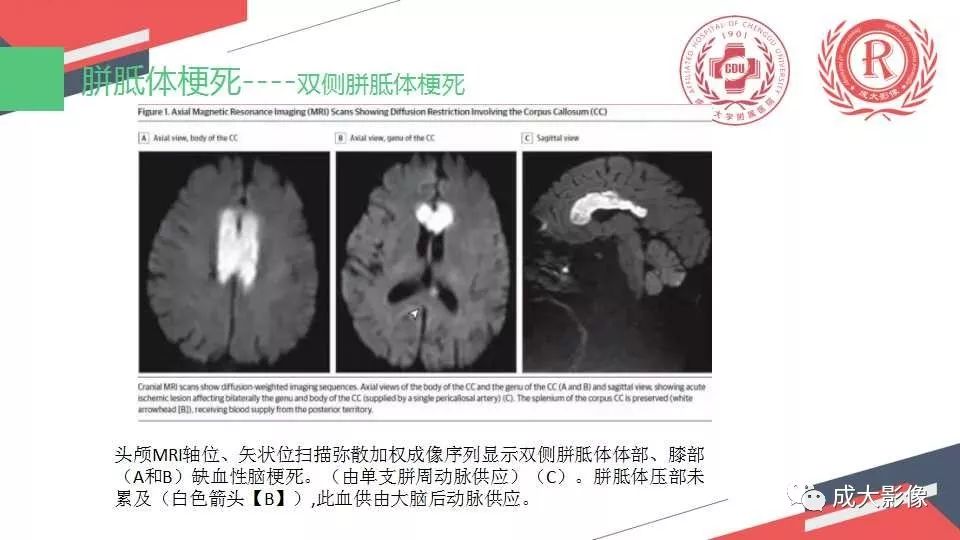 影像PPT - 【PPT】胼胝体病变MRI诊断-30