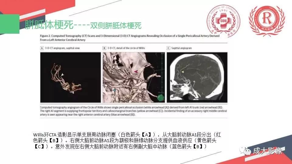 影像PPT - 【PPT】胼胝体病变MRI诊断-31