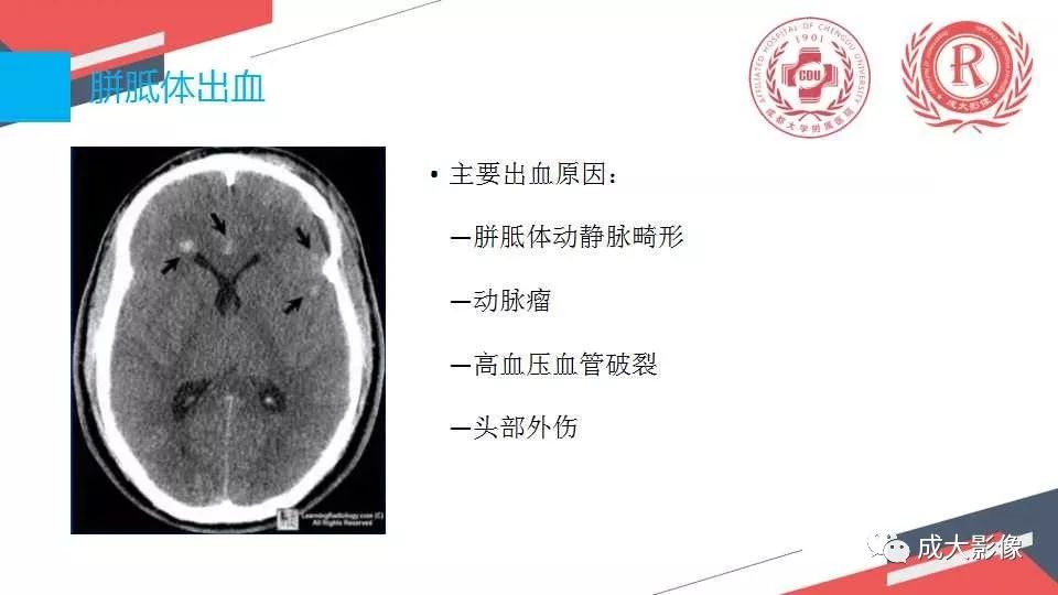 影像PPT - 【PPT】胼胝体病变MRI诊断-33