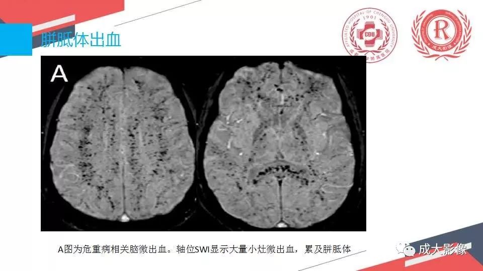 影像PPT - 【PPT】胼胝体病变MRI诊断-34