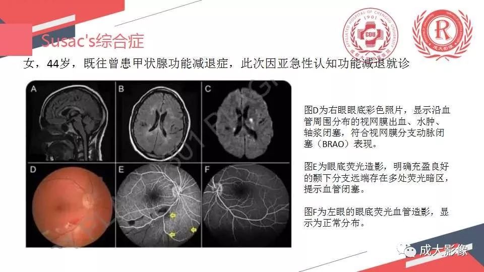 影像PPT - 【PPT】胼胝体病变MRI诊断-38