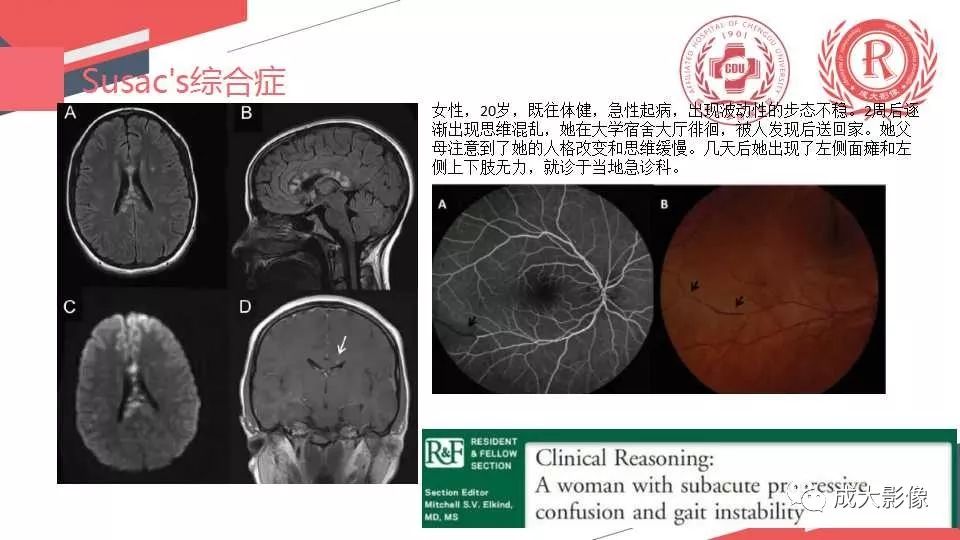 影像PPT - 【PPT】胼胝体病变MRI诊断-39