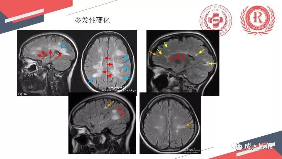 影像PPT - 【PPT】胼胝体病变MRI诊断-42