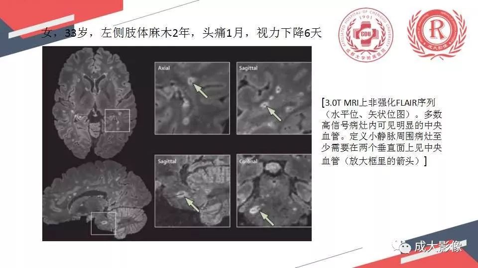 影像PPT - 【PPT】胼胝体病变MRI诊断-43