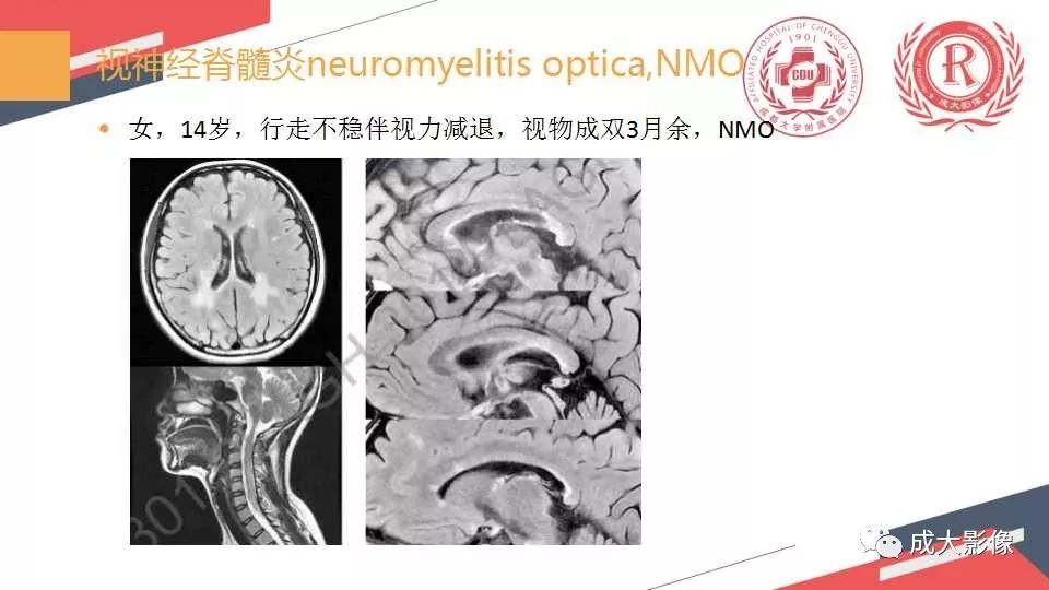 影像PPT - 【PPT】胼胝体病变MRI诊断-46