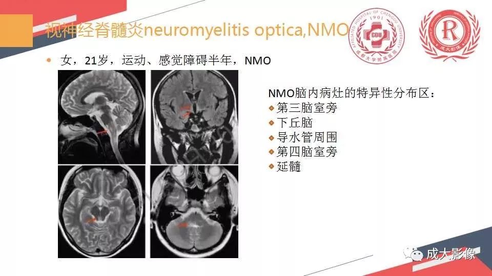 影像PPT - 【PPT】胼胝体病变MRI诊断-47