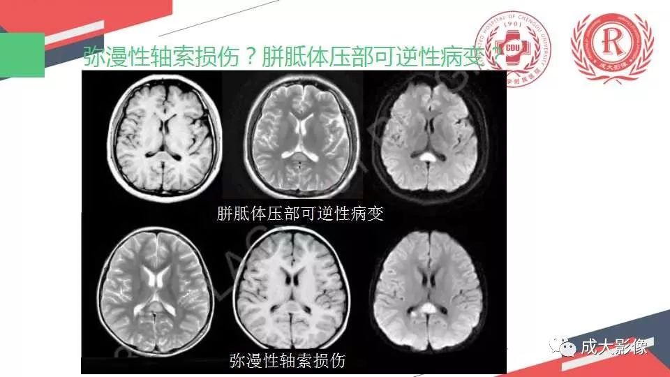 影像PPT - 【PPT】胼胝体病变MRI诊断-48