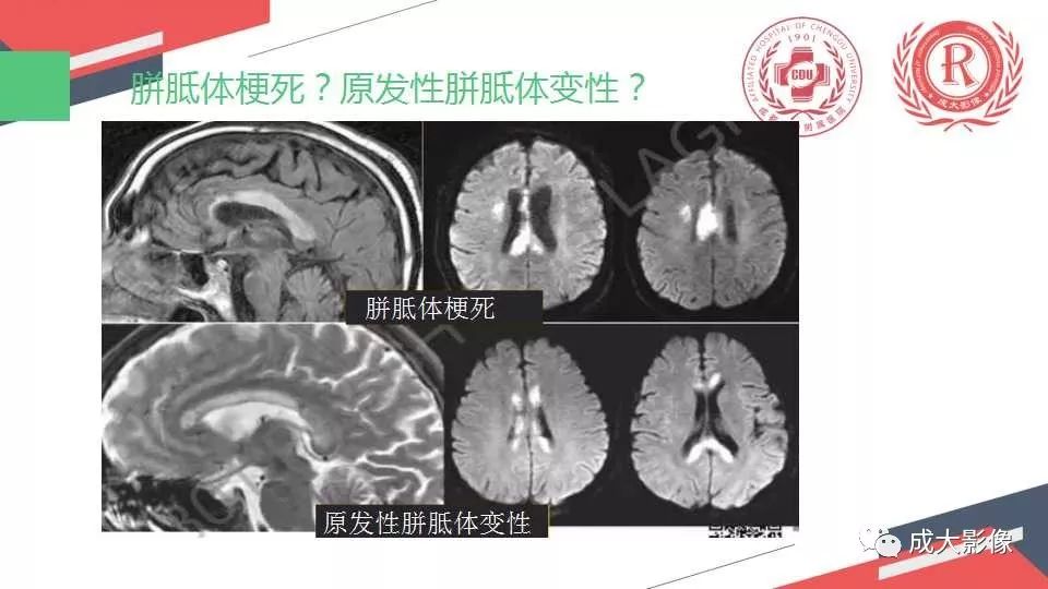 影像PPT - 【PPT】胼胝体病变MRI诊断-49