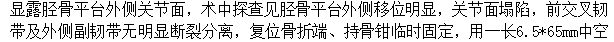 影像PPT - 【病例】Segond骨折前交叉韧带损伤1例MR-20