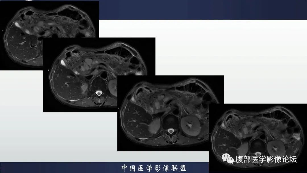 影像PPT - 【病例】胆管高分化腺癌1例CT及MR-3