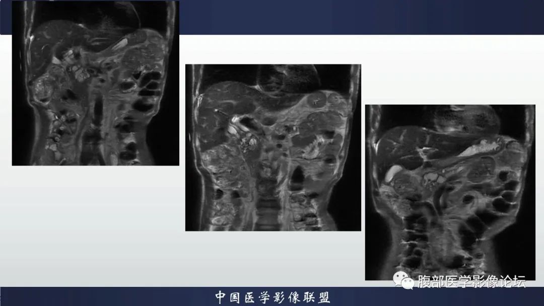 影像PPT - 【病例】胆管高分化腺癌1例CT及MR-5