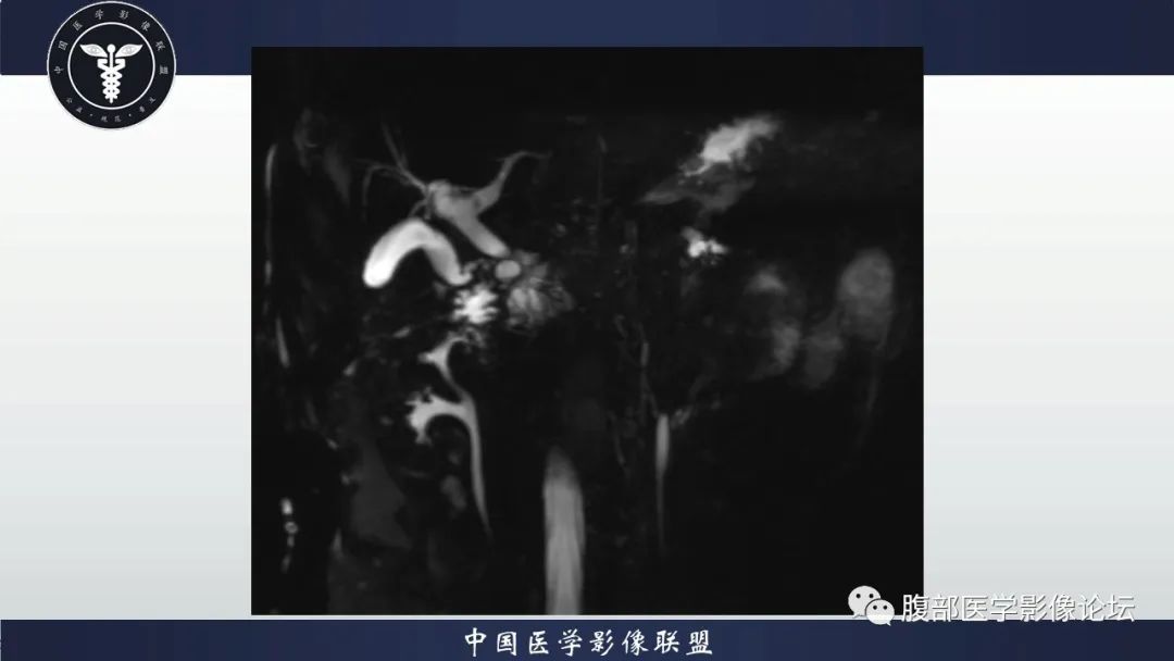 影像PPT - 【病例】胆管高分化腺癌1例CT及MR-7