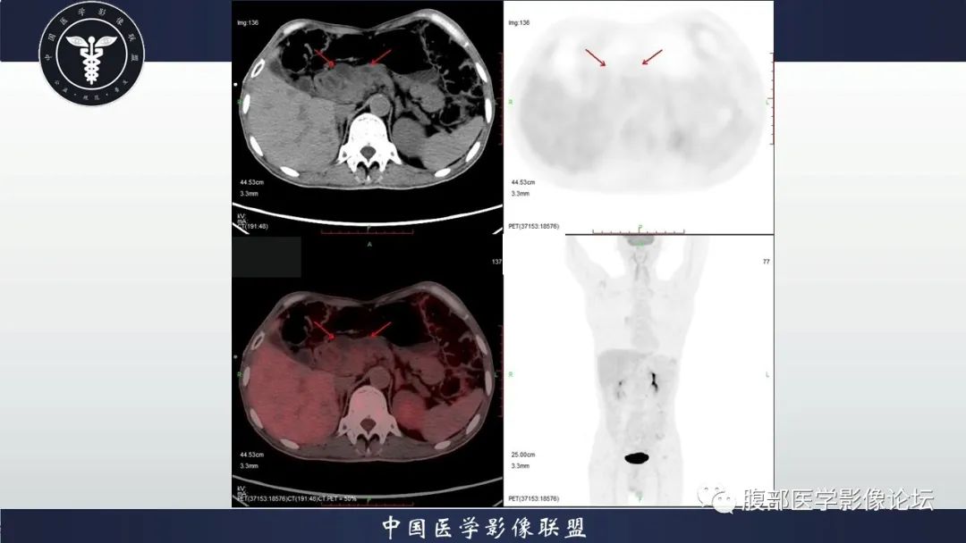 影像PPT - 【病例】胆管高分化腺癌1例CT及MR-9