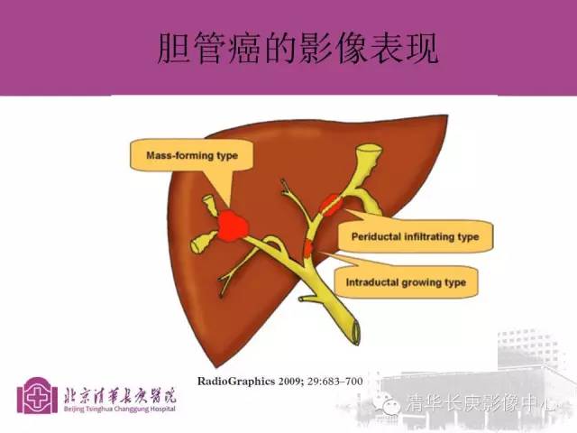 影像PPT - 【病例】胆管高分化腺癌1例CT及MR-18