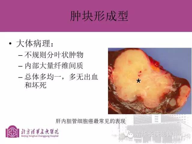 影像PPT - 【病例】胆管高分化腺癌1例CT及MR-19