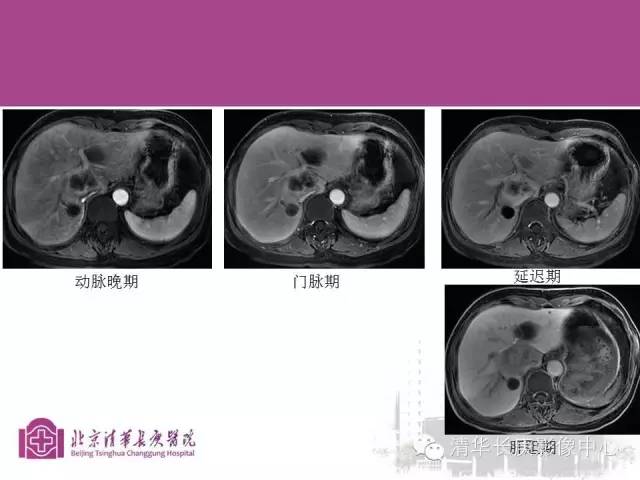 影像PPT - 【病例】胆管高分化腺癌1例CT及MR-23