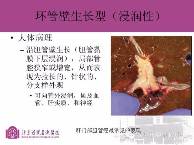 影像PPT - 【病例】胆管高分化腺癌1例CT及MR-25