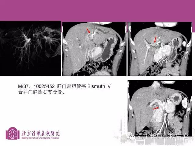 影像PPT - 【病例】胆管高分化腺癌1例CT及MR-27