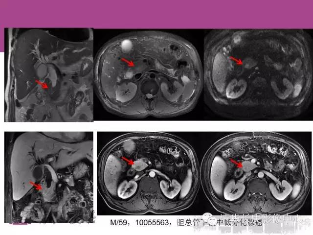 影像PPT - 【病例】胆管高分化腺癌1例CT及MR-28
