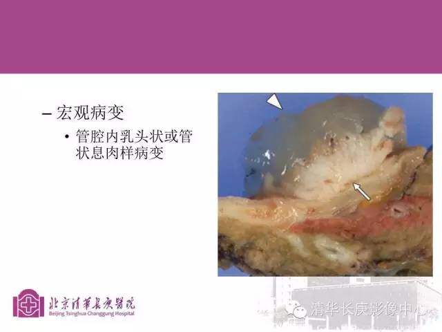 影像PPT - 【病例】胆管高分化腺癌1例CT及MR-31