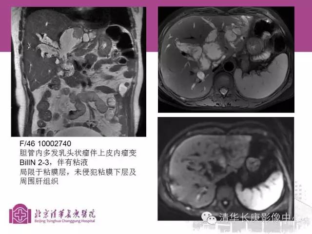 影像PPT - 【病例】胆管高分化腺癌1例CT及MR-33