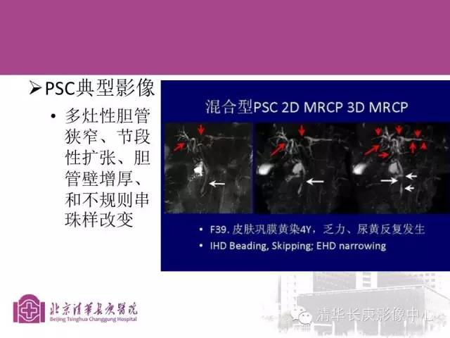 影像PPT - 【病例】胆管高分化腺癌1例CT及MR-36