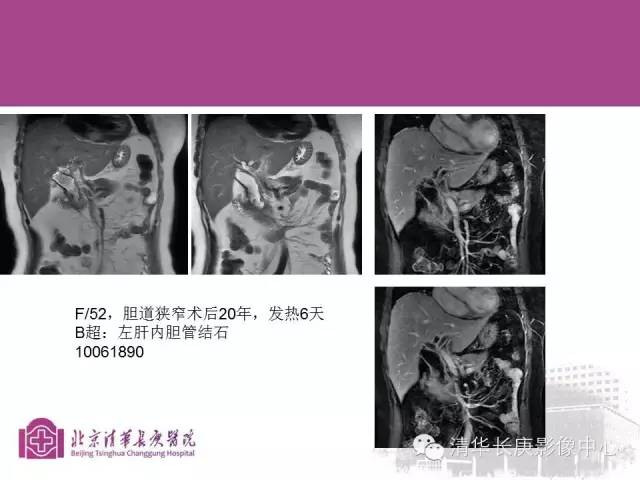 影像PPT - 【病例】胆管高分化腺癌1例CT及MR-38